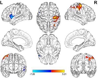 Altered thalamus functional connectivity in patients with acute unilateral vestibulopathy: a resting-state fMRI study